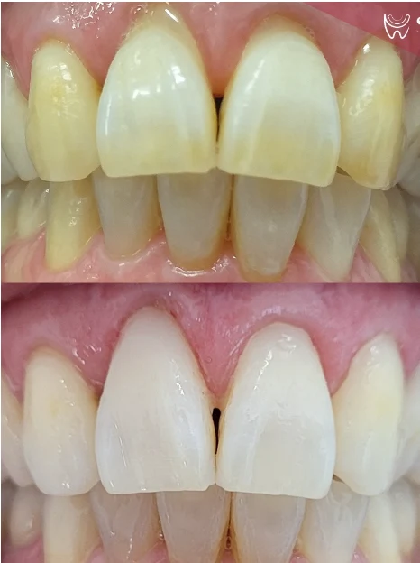 Antes e depois de clareamento dental na Sobilis Odontologia Humanizada — Itapoã, Belo Horizonte