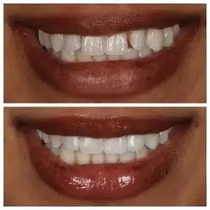Antes e depois de clareamento e estética do sorriso — Sobilis, Itapoã, BH