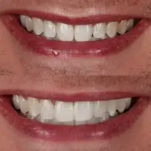 Antes e depois de clareamento e lentes de contato — Sobilis Odontologia, Belo Horizonte