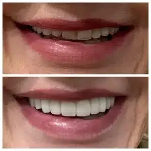 Antes e depois de facetas de porcelana cor e forma — Sobilis, Itapoã, BH