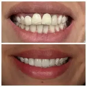 Antes e depois de facetas de porcelana substituindo coroas — Sobilis, Belo Horizonte