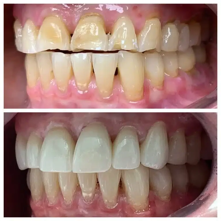 Antes e depois de facetas de porcelana para desgaste dental — Sobilis Odontologia, Belo Horizonte