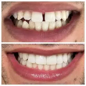 Antes e depois de facetas de porcelana — transformação do sorriso, Sobilis Itapoã