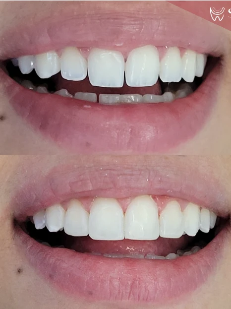 Antes e depois de facetas em resina no contorno dos incisivos — Sobilis Odontologia, Belo Horizonte