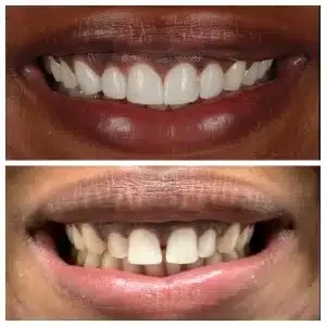 Antes e depois de facetas em resina estética — Sobilis, Itapoã, Belo Horizonte