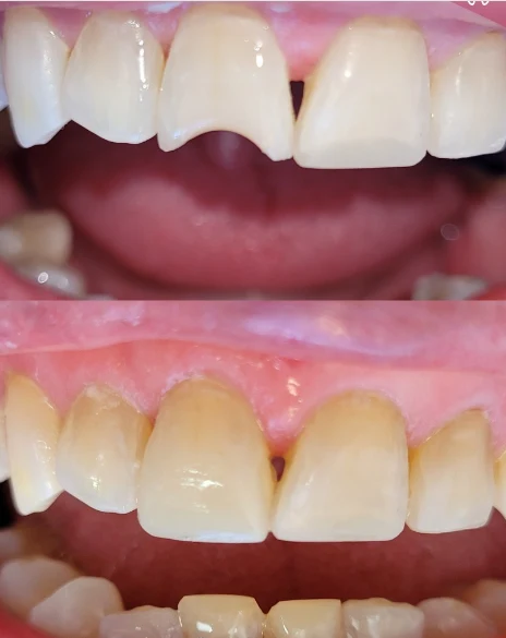 Antes e depois de facetas em resina no incisivo central com entalhe — Sobilis Odontologia, Itapoã, BH