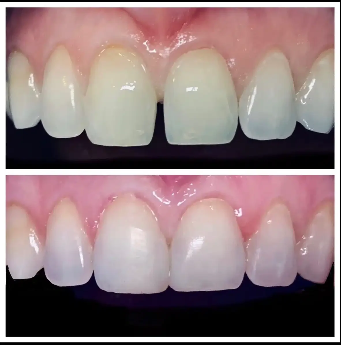 Antes e depois de fechamento de diastema estética dental — Sobilis, Itapoã, Belo Horizonte
