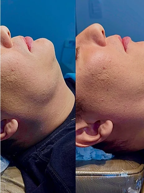 Antes e depois de harmonização facial do contorno mandibular em perfil — Sobilis Odontologia, Itapoã, BH