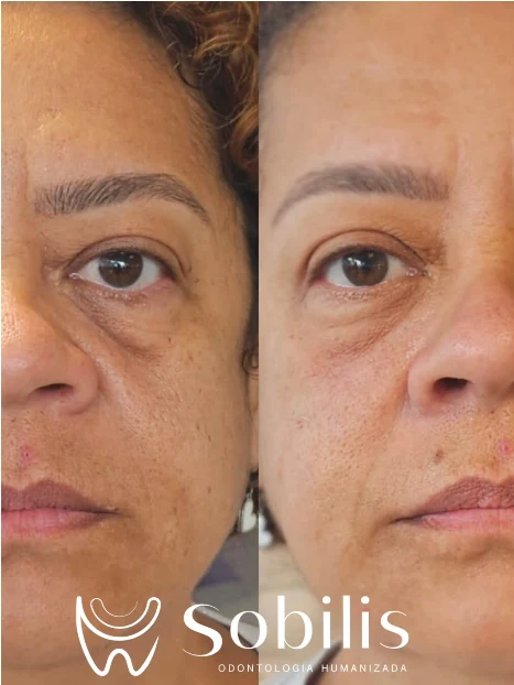 Antes e depois de harmonização facial — olheiras e sulcos nasogenianos — Sobilis Odontologia, Belo Horizonte