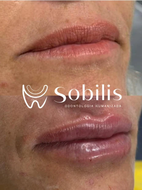 Antes e depois de harmonização labial na Sobilis Odontologia Humanizada — Itapoã, Belo Horizonte