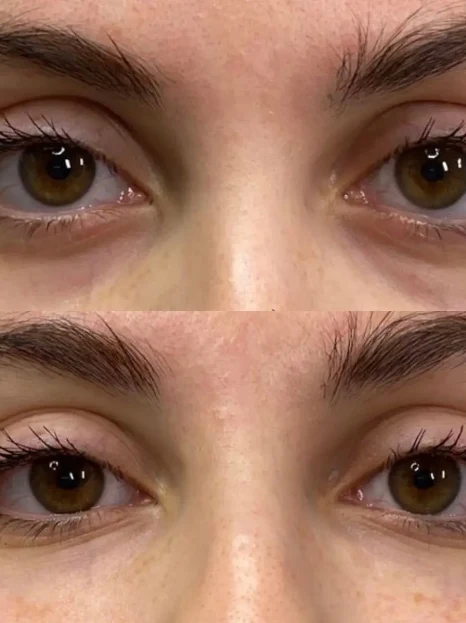 Antes e depois de preenchimento de olheiras — harmonização facial Sobilis, Belo Horizonte, Itapoã