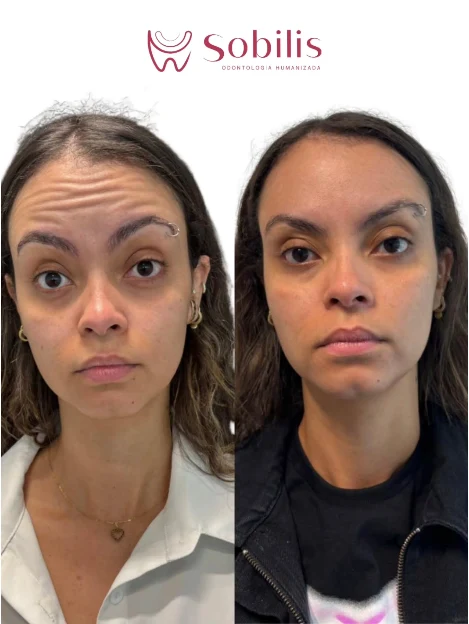 Antes e depois de toxina botulínica na testa — harmonização facial Sobilis Odontologia, Belo Horizonte