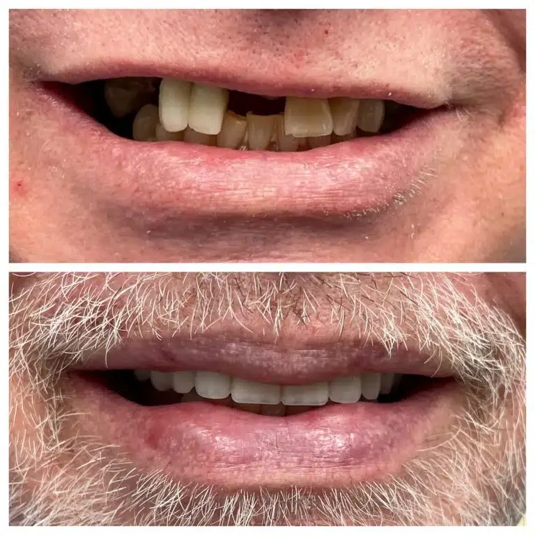 Antes e depois de implante dentário no arco superior — dentista Itapoã, Belo Horizonte