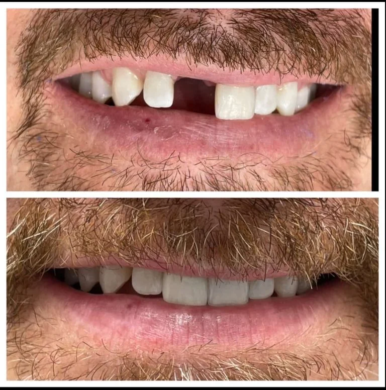 Antes e depois de implante dentário em dente anterior — Sobilis, Itapoã, BH