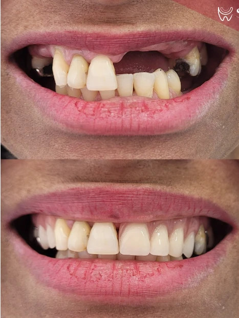 Antes e depois de implante dentário em incisivos ausentes — Sobilis Odontologia Humanizada, Itapoã, BH