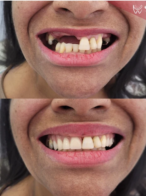 Antes e depois de reabilitação oral com implantes dentários na arcada superior anterior — Sobilis Odontologia, Itapoã, Belo Horizonte