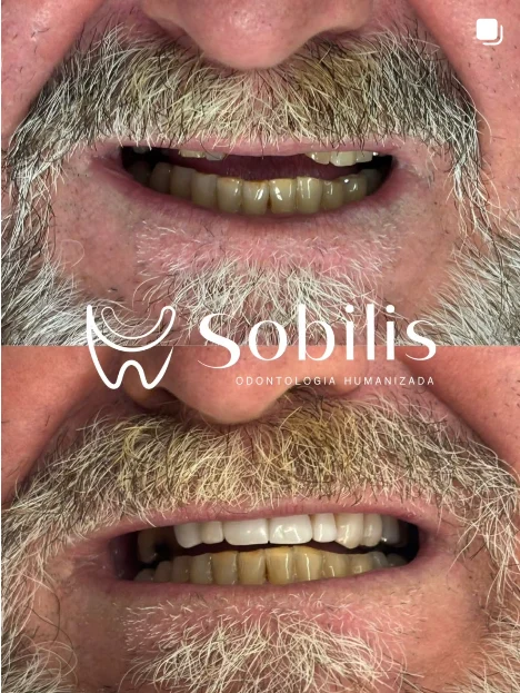 Antes e depois de implante dentário com prótese na arcada superior — Sobilis Odontologia Humanizada, Belo Horizonte
