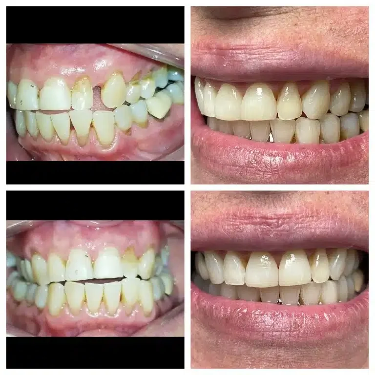 Antes e depois de implante dentário unitário e sorriso — Sobilis Odontologia Humanizada, Itapoã