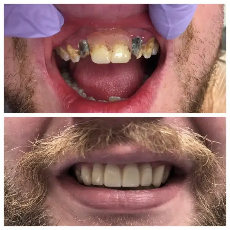 Antes e depois de implante com prótese protocolo — Sobilis Odontologia, BH