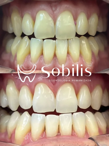 Antes e depois de lentes de contato e clareamento com afastador — Sobilis Odontologia, Itapoã, Belo Horizonte