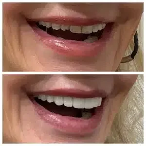 Antes e depois de lentes de contato com alinhamento — Sobilis Odontologia, Belo Horizonte