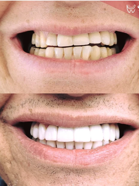 Antes e depois de lentes de contato com alinhamento e clareamento — Sobilis Odontologia Humanizada, Itapoã, BH
