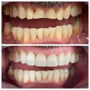 Antes e depois de lentes de contato e clareamento — Sobilis Odontologia Humanizada, Itapoã