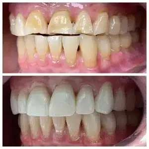 Antes e depois de lentes de contato dental — Sobilis, Itapoã, Belo Horizonte