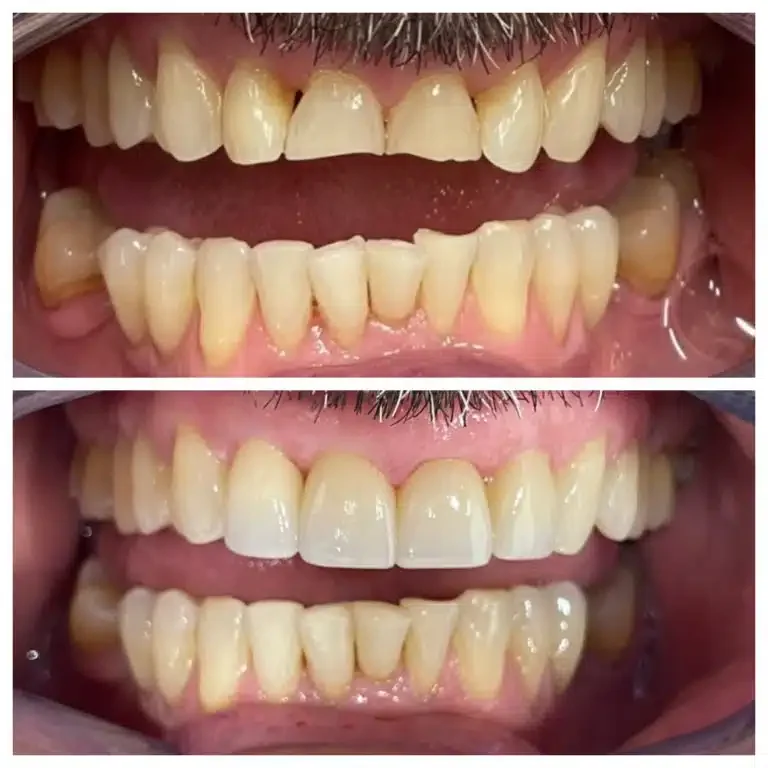 Antes e depois de lentes de contato para desgaste — Sobilis Odontologia Humanizada, BH