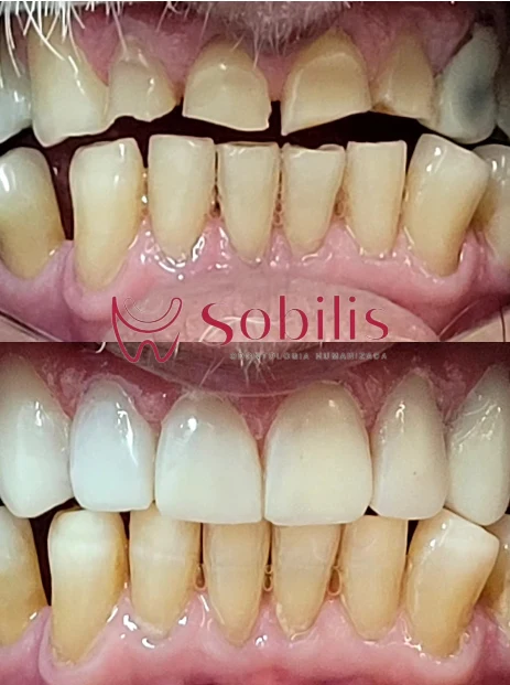 Antes e depois de lentes de contato para dentes desgastados — Sobilis Odontologia Humanizada, Belo Horizonte