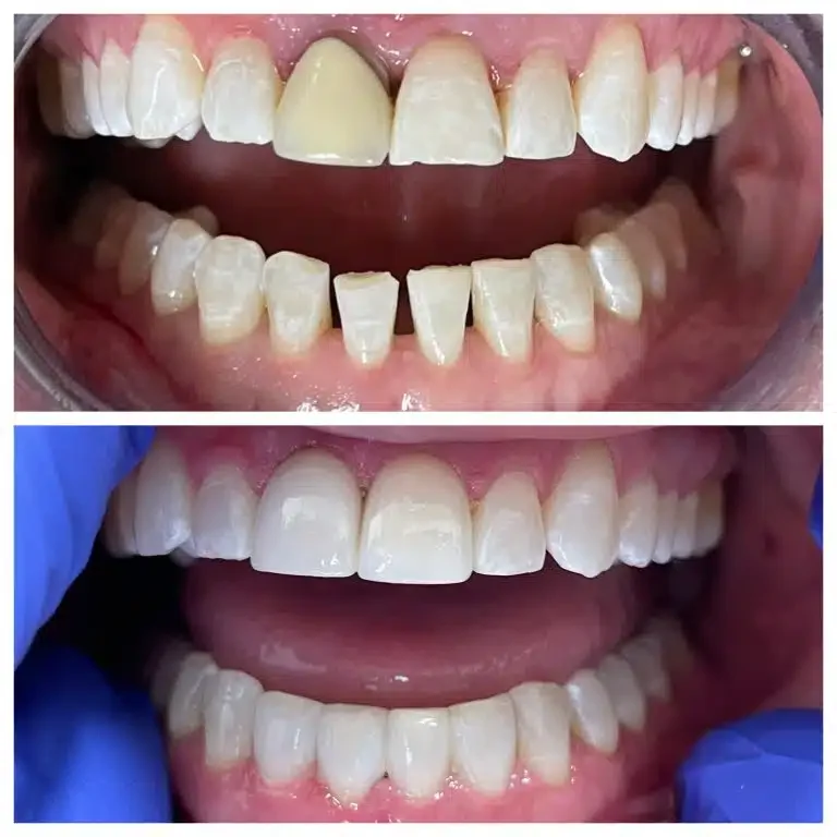 Antes e depois de lentes de contato para diastema — Sobilis, Itapoã, zona norte BH