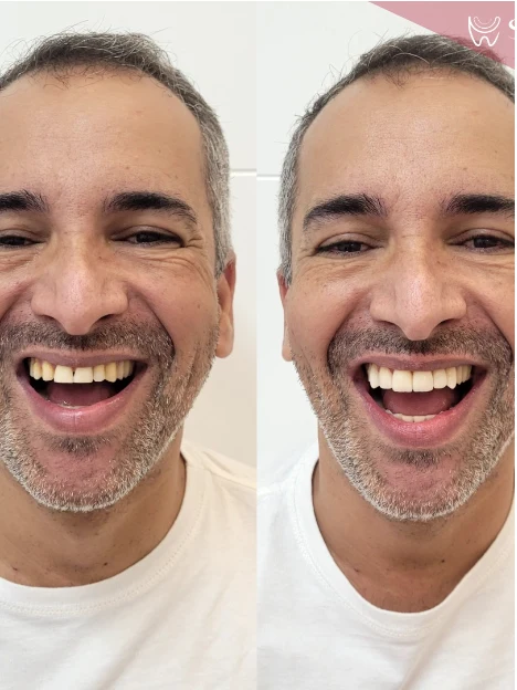 Antes e depois de lentes de contato com fechamento de diastema — Sobilis Odontologia, Belo Horizonte