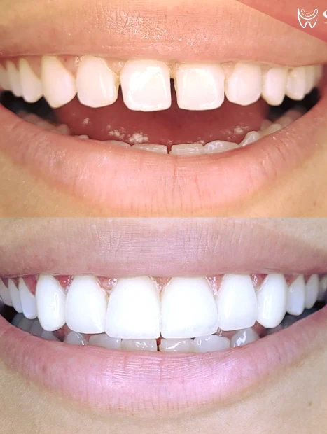 Antes e depois de lentes de contato com fechamento de diastema no sorriso — Sobilis, Belo Horizonte