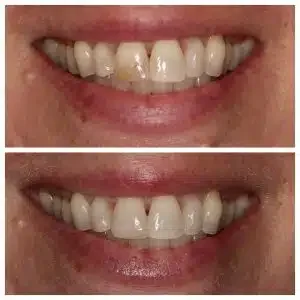 Antes e depois de lentes de contato harmonização — Sobilis Odontologia, Itapoã