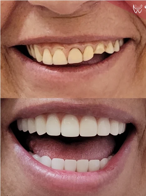 Antes e depois de lentes de contato em incisivo fraturado — Sobilis Odontologia Humanizada, Itapoã, BH