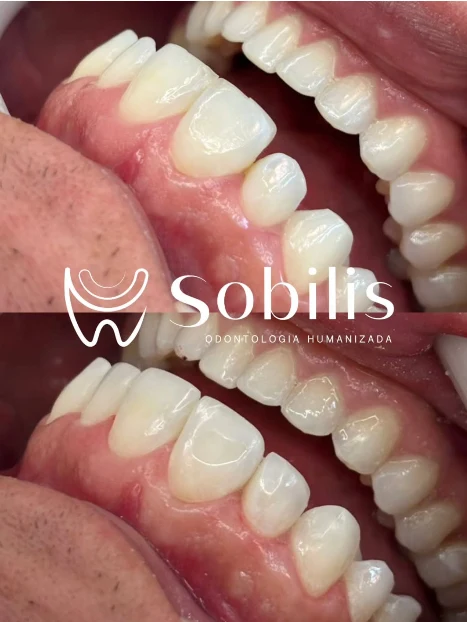 Antes e depois lateral de lentes de contato dental na Sobilis Odontologia Humanizada — Belo Horizonte, Itapoã