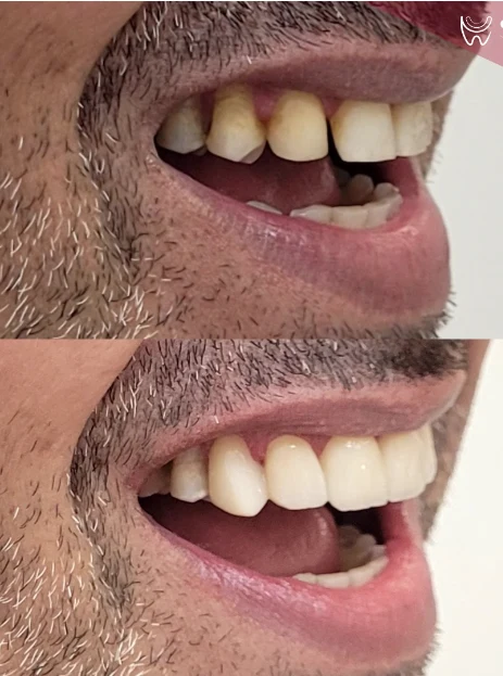 Antes e depois de lentes de contato em perfil lateral — Sobilis Odontologia Humanizada, Belo Horizonte