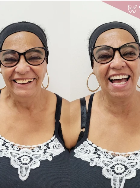 Antes e depois de lentes de contato em retrato de paciente adulta — Sobilis Odontologia Humanizada, Itapoã, BH