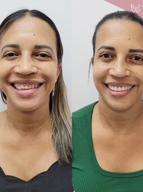 Antes e depois de lentes de contato em retrato — paciente feminina, Sobilis, Belo Horizonte