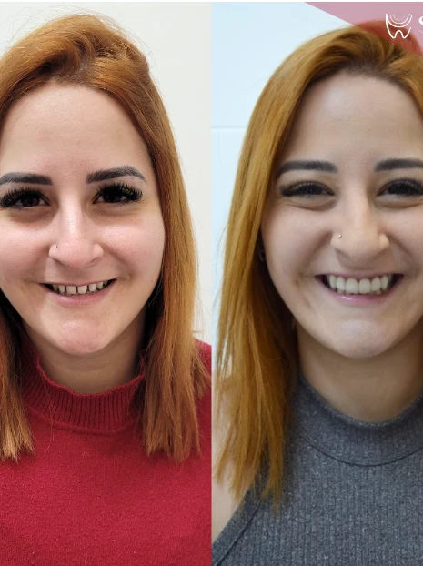 Antes e depois em retrato feminino com lentes de contato — Sobilis Odontologia Humanizada, Itapoã, BH