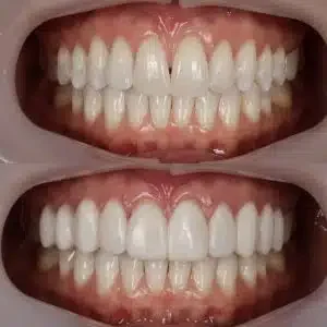 Antes e depois de lentes de contato em registro clínico — Sobilis, Belo Horizonte, Itapoã