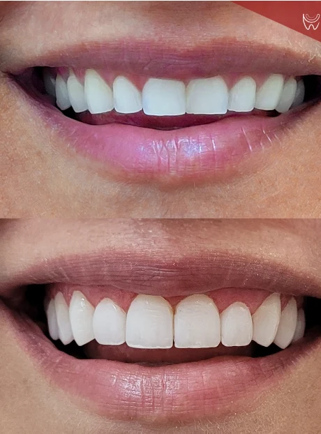 Antes e depois de lentes de contato no sorriso anterior — Sobilis Odontologia Humanizada, Itapoã, BH