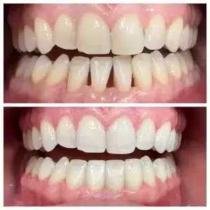 Antes e depois de lentes de contato para sorriso harmônico — Sobilis, BH