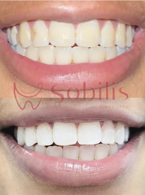 Antes e depois de lentes de contato dental e clareamento na Sobilis Odontologia Humanizada — Itapoã, Belo Horizonte