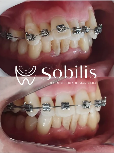 Antes e depois de ortodontia com aparelho fixo metálico na Sobilis Odontologia Humanizada — Itapoã, Belo Horizonte