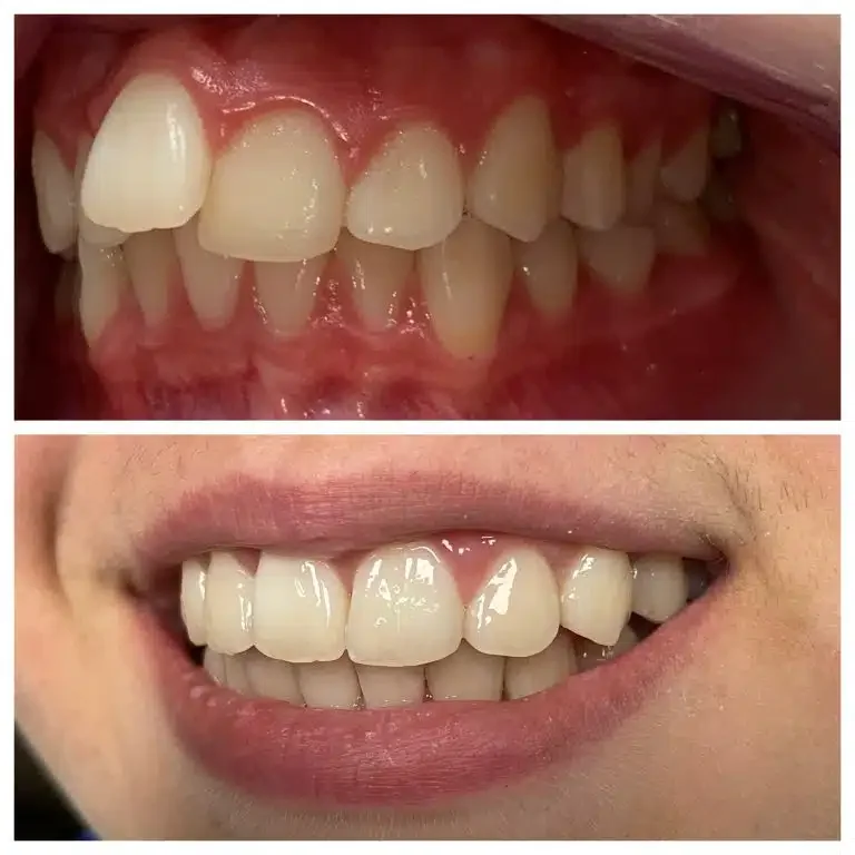Antes e depois de ortodontia e lentes de contato — Sobilis Odontologia Humanizada, Itapoã, BH