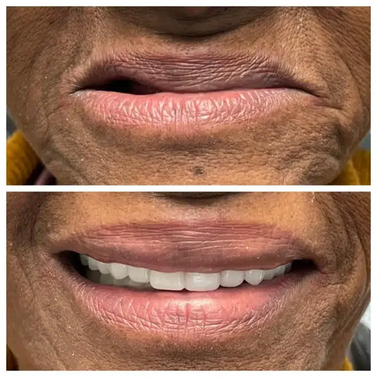 Antes e depois de prótese protocolo e reabilitação oral — Sobilis, Itapoã, Belo Horizonte