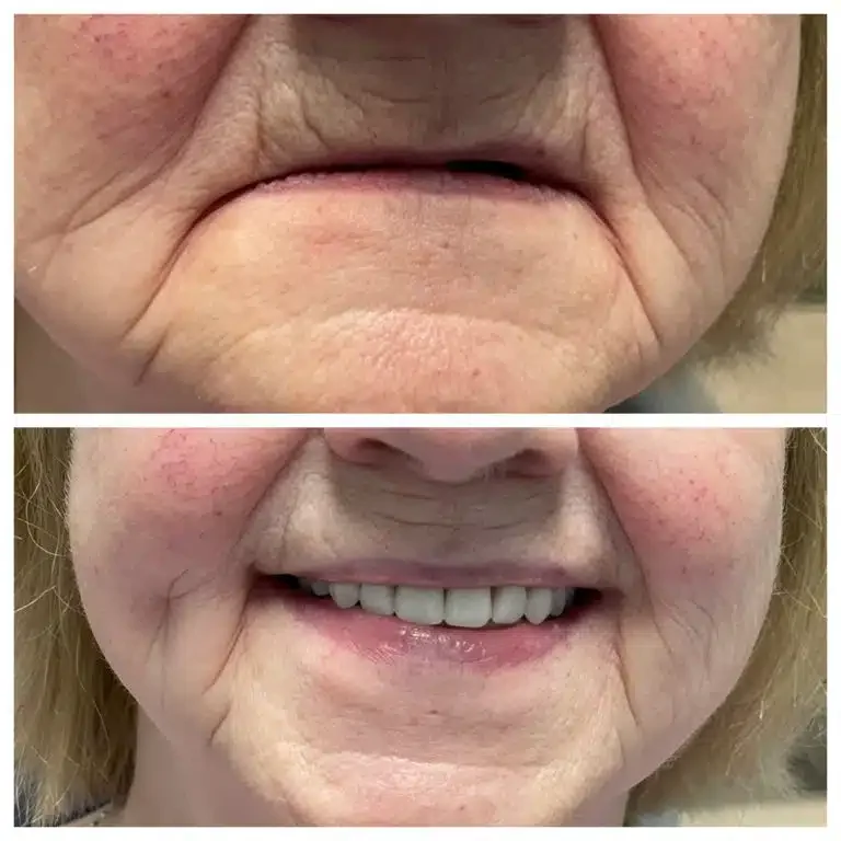 Antes e depois de reabilitação oral com dimensão vertical — Sobilis, Itapoã, zona norte BH