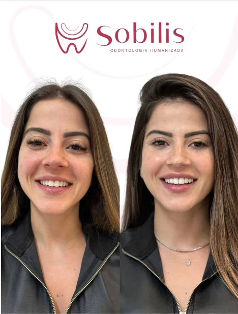 Antes e depois de harmonização do sorriso em retrato — Sobilis Odontologia Humanizada, Itapoã, BH