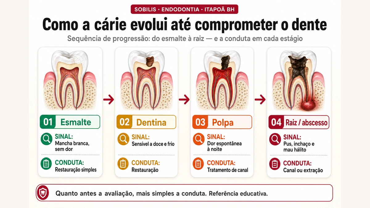 Infográfico da progressão da cárie: esmalte, dentina, polpa e raiz com abscesso — Sobilis Odontologia, Itapoã BH